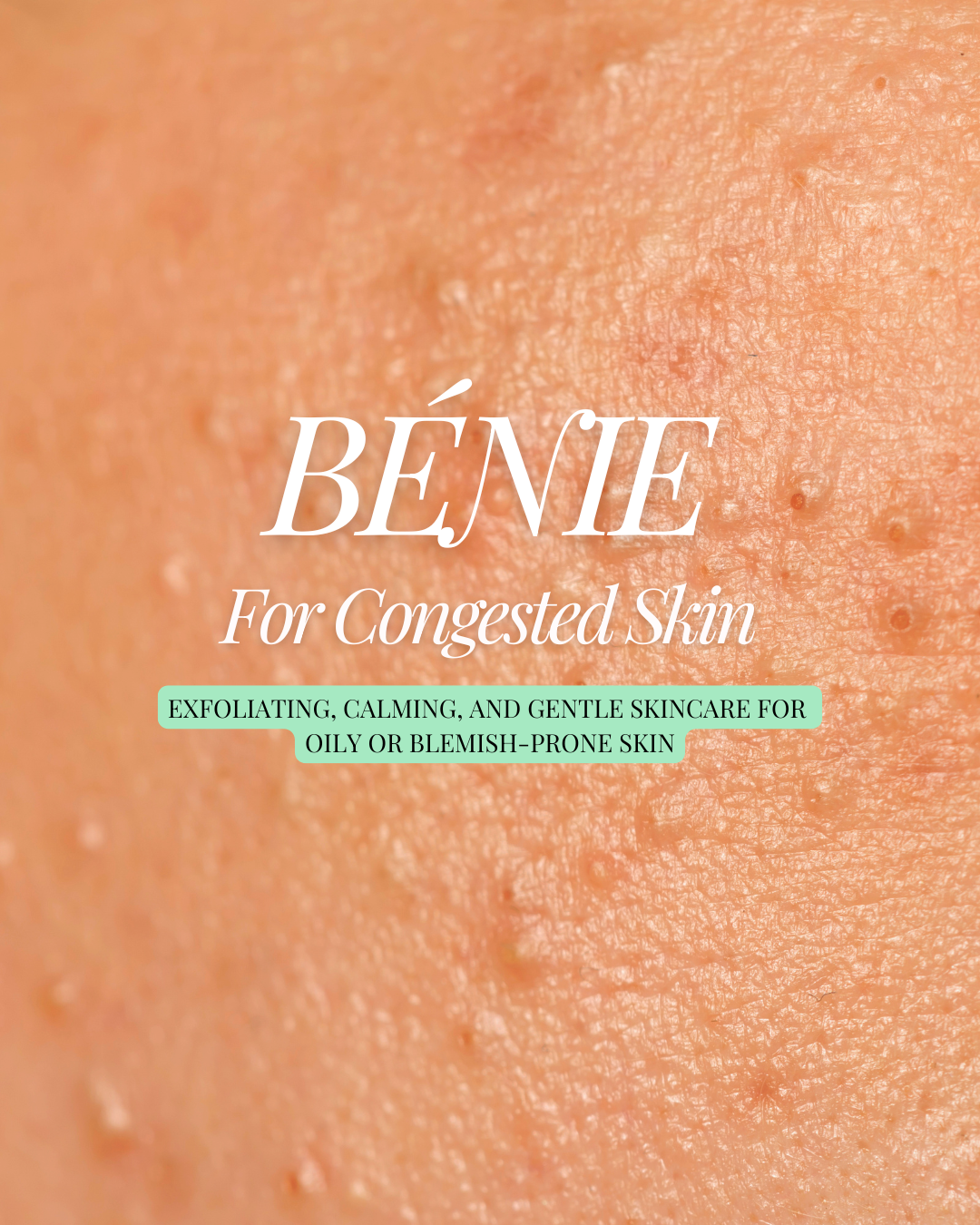 For Congestion-Prone Skin